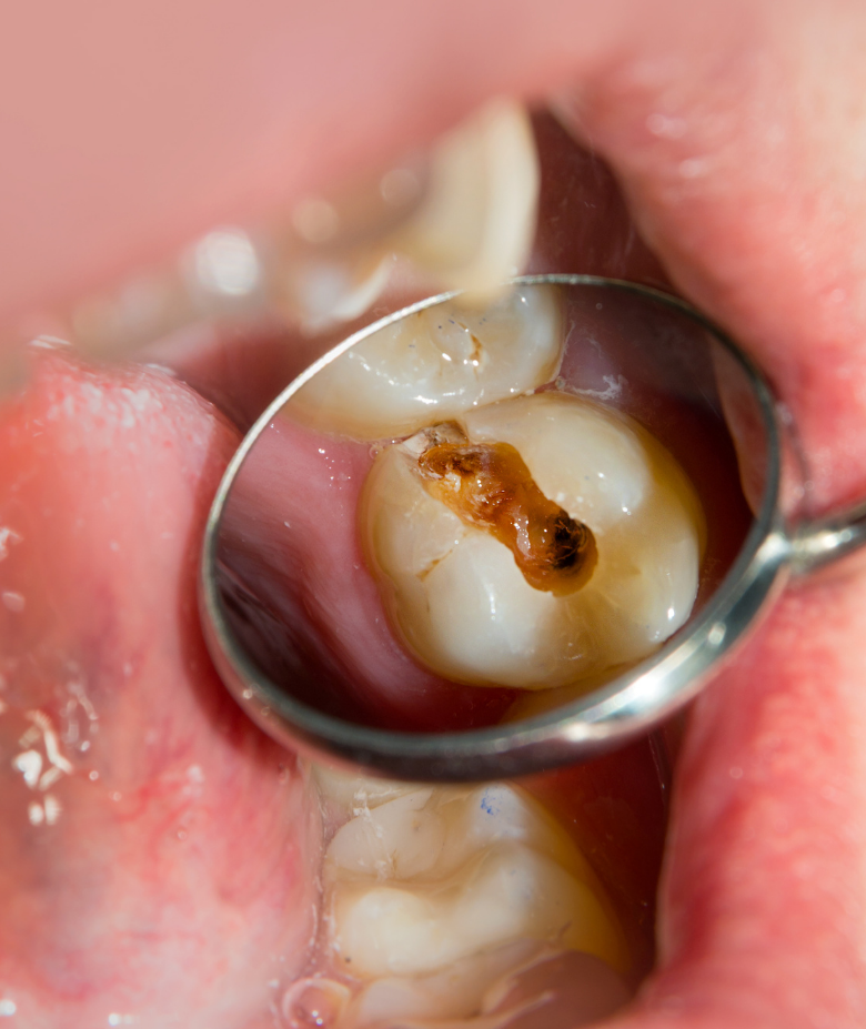 5x Lime Endodontiche Manuali In Acciaio Inox Per Canali Radicolari - Varie Misure